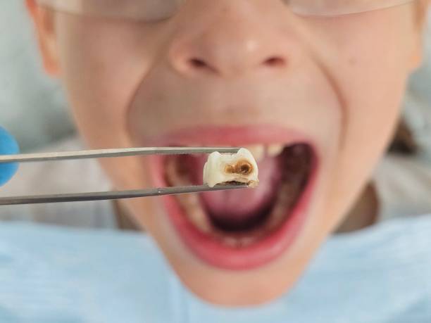 Tooth Infection Emergency Dentist in WY